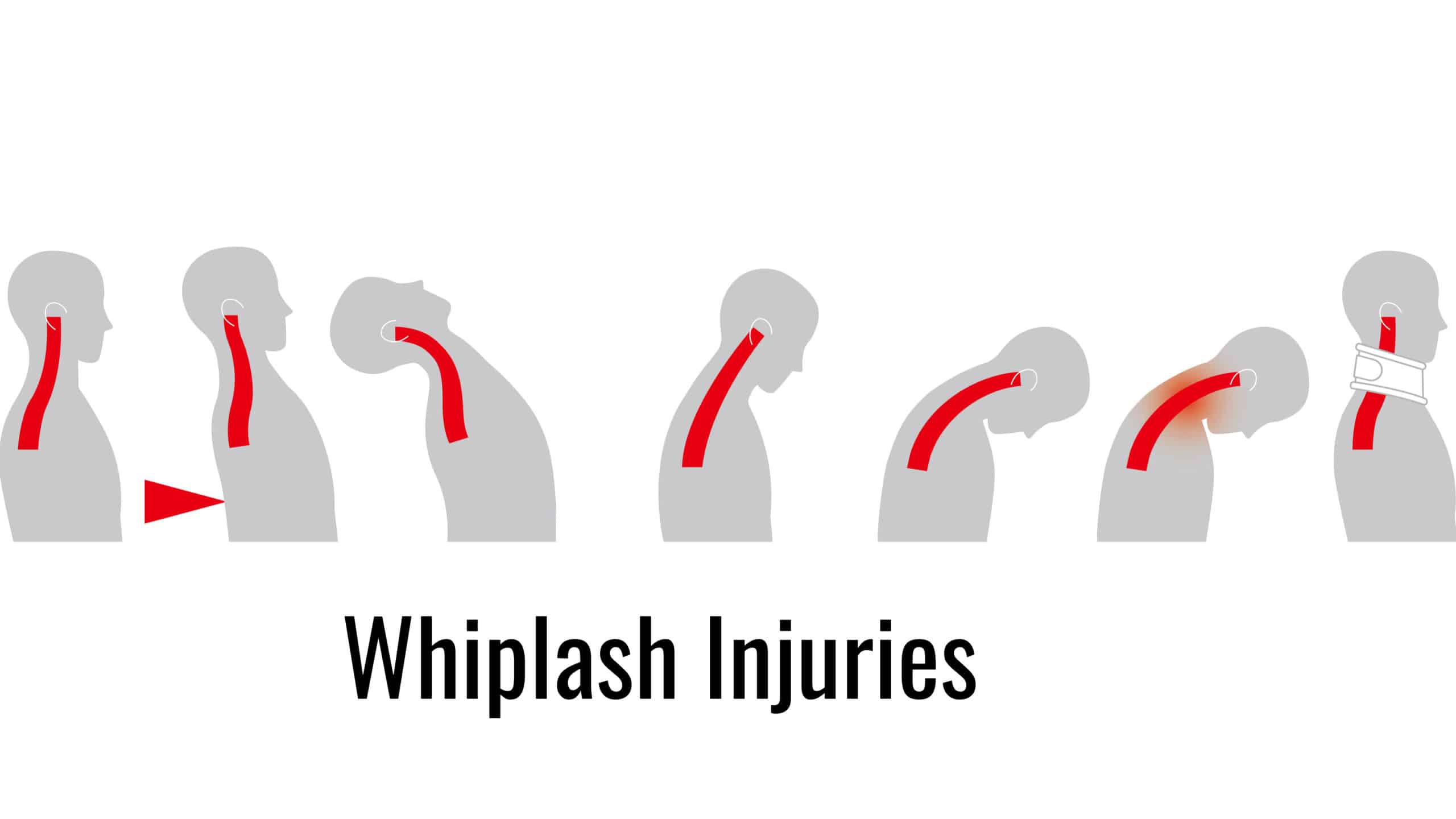 Medical diagram of what victim looks like sustaining whiplash injury
