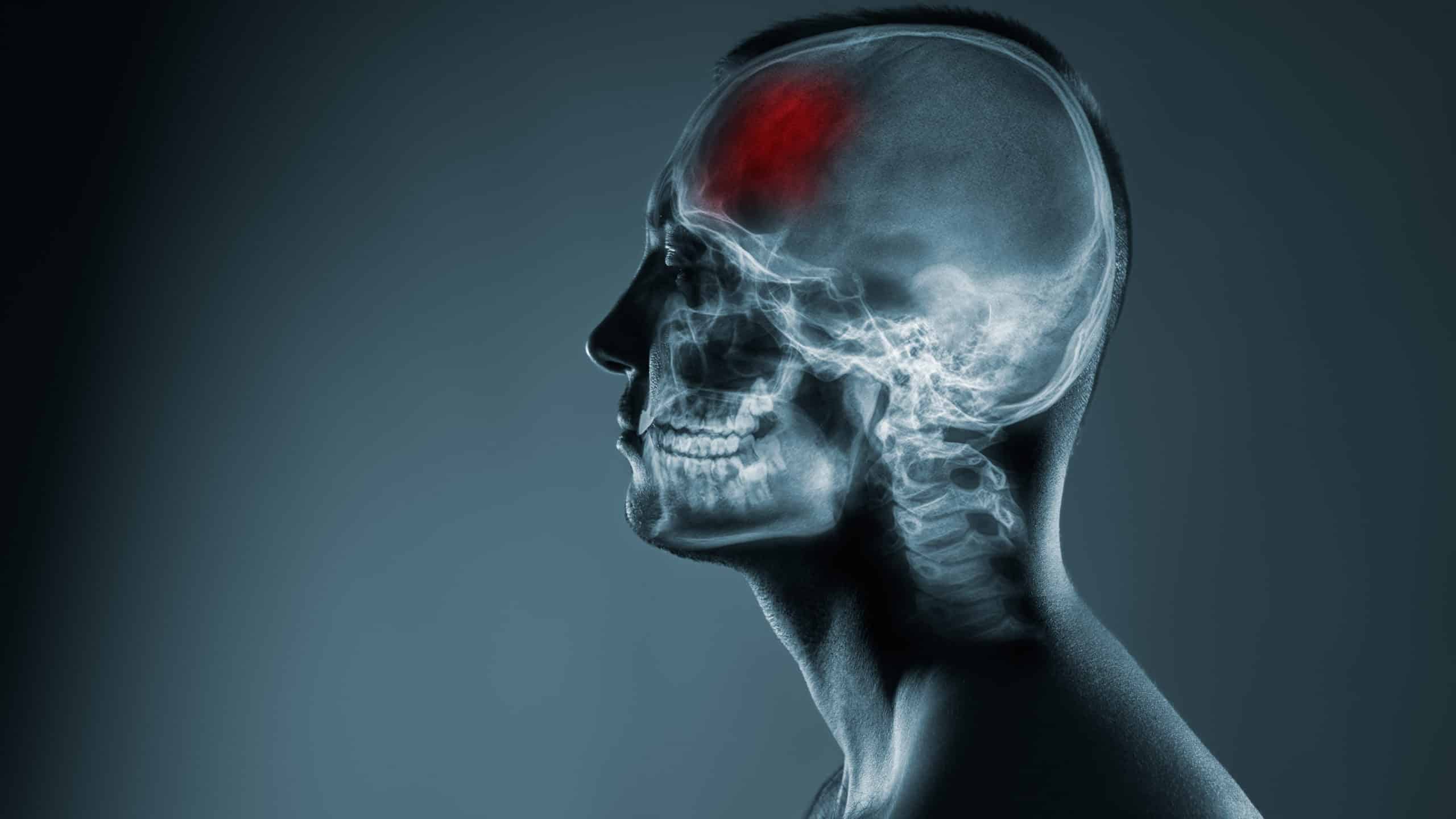 Traumatic Brain Injury- Wilshire Law